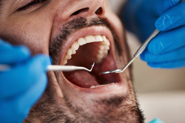 Best Emergency Tooth Extraction in Sparta, MI